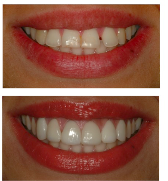 Come sbiancare i denti se alcuni sono finti | Notizie.it